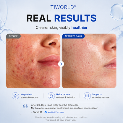 Tiworld® 4-in-1 Bio-Active Protocol: Anti-Acne, Calming, Mark-Fading & Oil-Control
