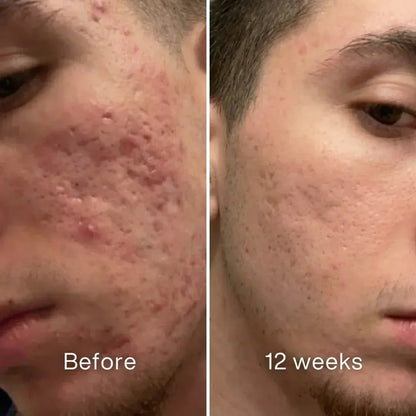 Tiworld® Clinical Acne Scar Repair Stick