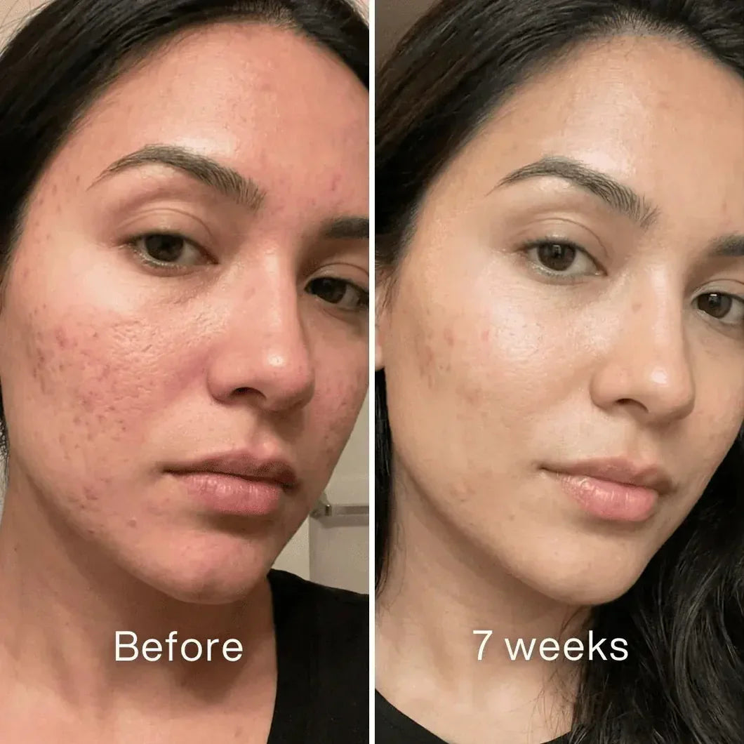 Tiworld® Clinical Acne Scar Repair Stick