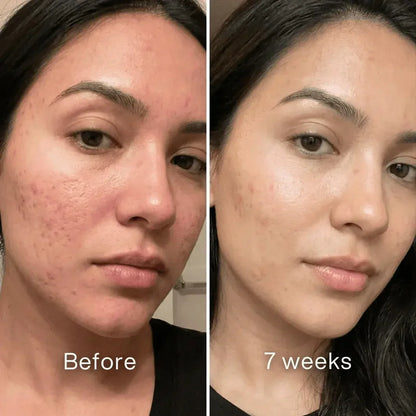 Tiworld® Clinical Acne Scar Repair Stick